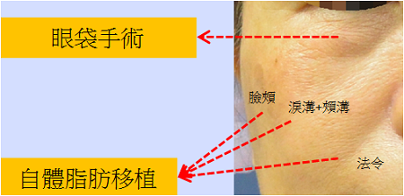 自體脂肪補臉案例