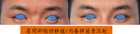 自體脂肪補臉案例