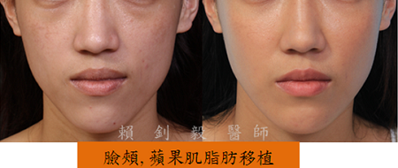 自體脂肪補臉案例
