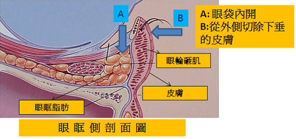 眼眶側剖面圖