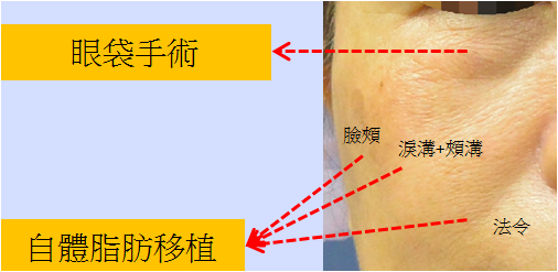眼袋手術+自體脂肪移植